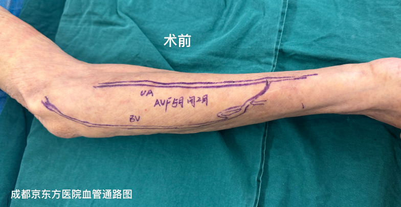高龄复杂肾病患者自体内瘘成功开通,告别透析导管有望!