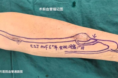 无症状不等于零风险！成都京东方医院通路团队精准评估，微创复通透析患者陈旧内瘘慢性闭塞