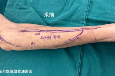 高龄复杂肾病患者自体内瘘成功开通，告别透析导管有望！