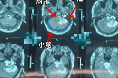听力下降、耳鸣拖延 10 年！医生「挖出」巨大高危脑肿瘤
