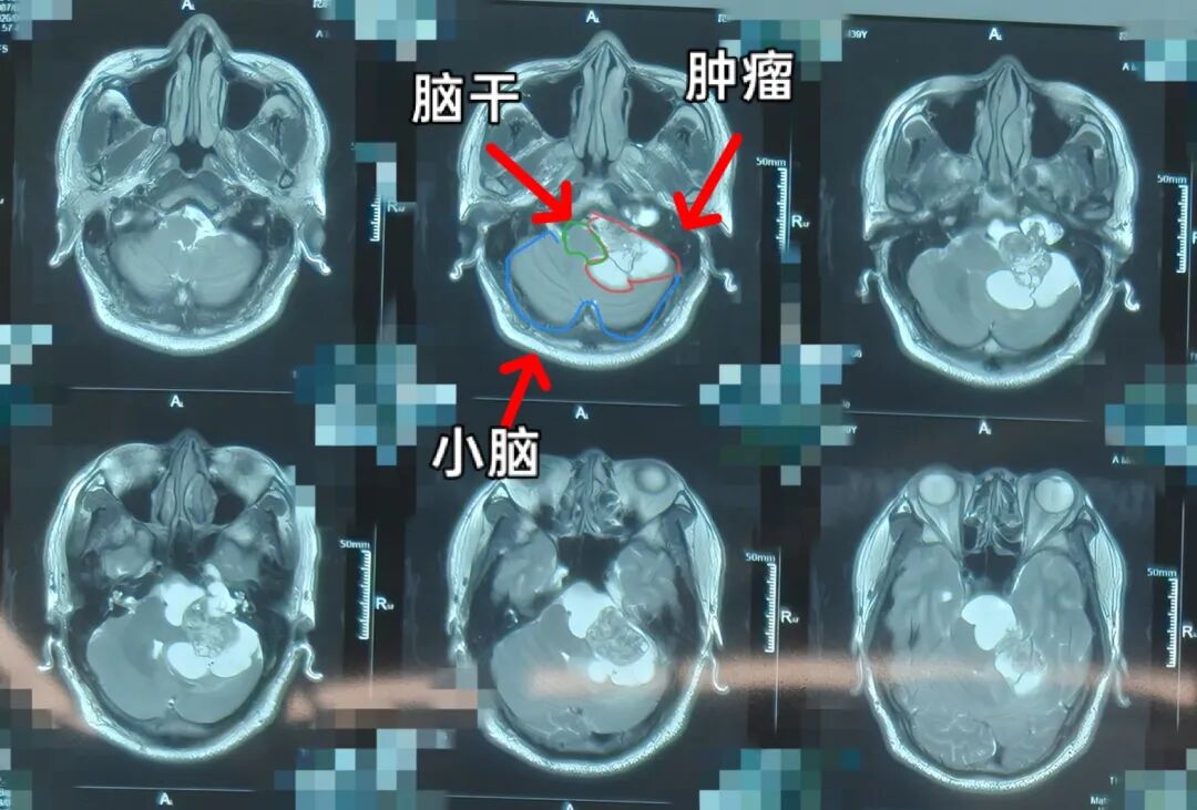 听力下降、耳鸣拖延 10 年!医生「挖出」巨大高危脑肿瘤