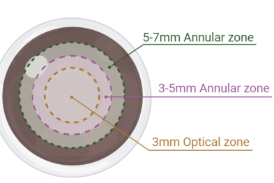 光迹追踪引导的 LASIK 手术通过空间选择性周边基质消融维持角膜非球面性