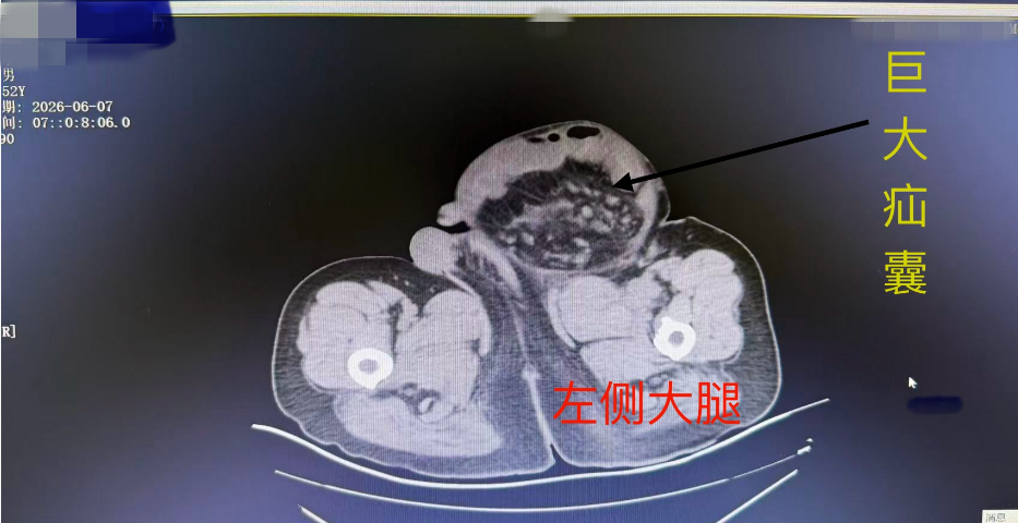 二十天疯长至 70 厘米!暴走的腹股沟疝气