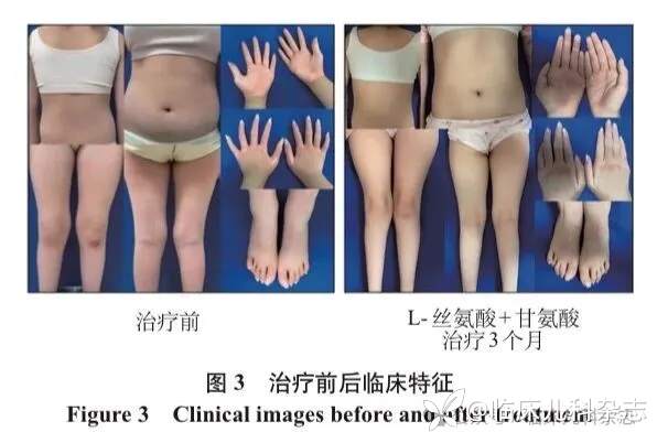 PSAT1 基因变异致轻型丝氨酸缺乏症:以鱼鳞病合并周围神经病为表型的临床特征与遗传学分析