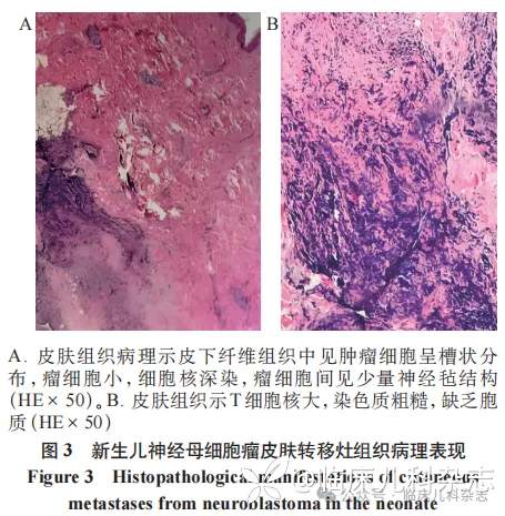 以头顶部单发淡蓝色结节为首发表现的新生儿神经母细胞瘤 1 例报告