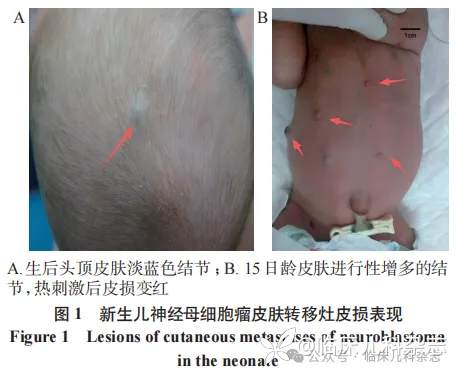 以头顶部单发淡蓝色结节为首发表现的新生儿神经母细胞瘤 1 例报告