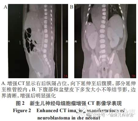 以头顶部单发淡蓝色结节为首发表现的新生儿神经母细胞瘤 1 例报告