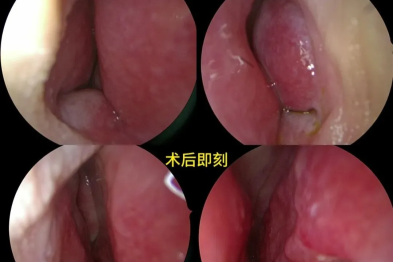 被鼻炎困扰 6 年：一场不断突围的「呼吸救赎」
