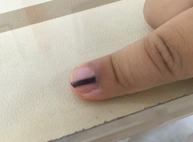 三岁宝宝指甲上冒出一条黑线,是「癌」还是「痣」?合肥京东方医院甲外科专家邹文杰讲解甲黑线
