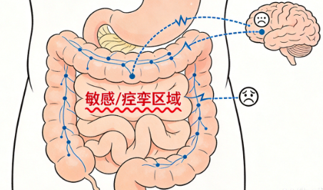 肠易激综合征:难以言说的"肠道敏感"