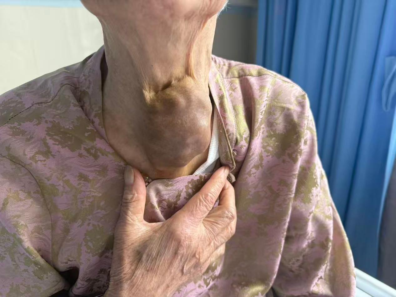 耄耋老人甲状腺巨大肿瘤拖延十余载险窒息 多学科专家联手解除致命压迫
