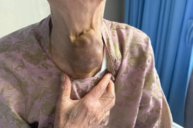 耄耋老人甲状腺巨大肿瘤拖延十余载险窒息 多学科专家联手解除致命压迫