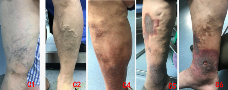 告别「蚯蚓腿」——融合 CHIVA 理念的新消融术