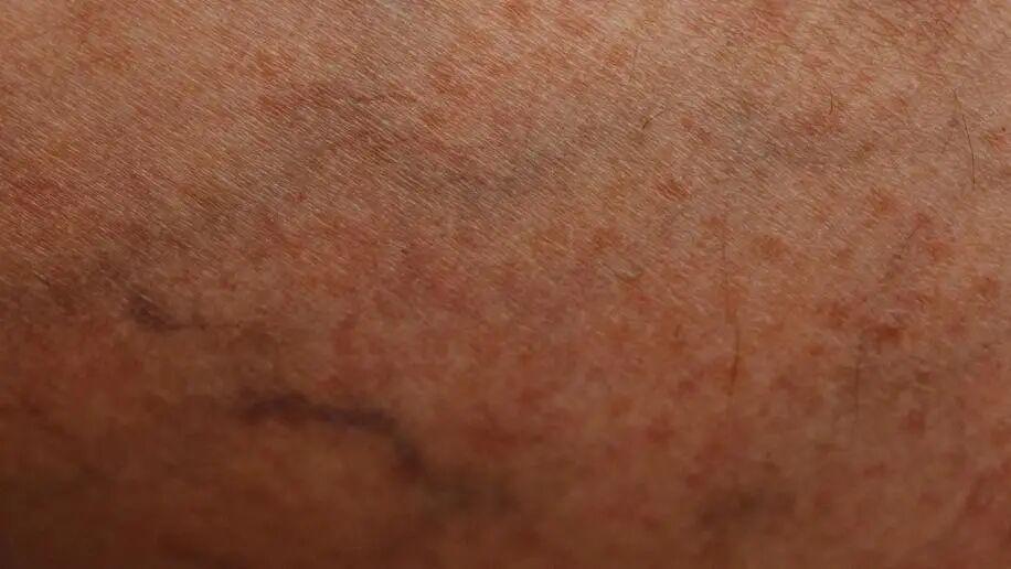 告别「蚯蚓腿」——融合 CHIVA 理念的新消融术