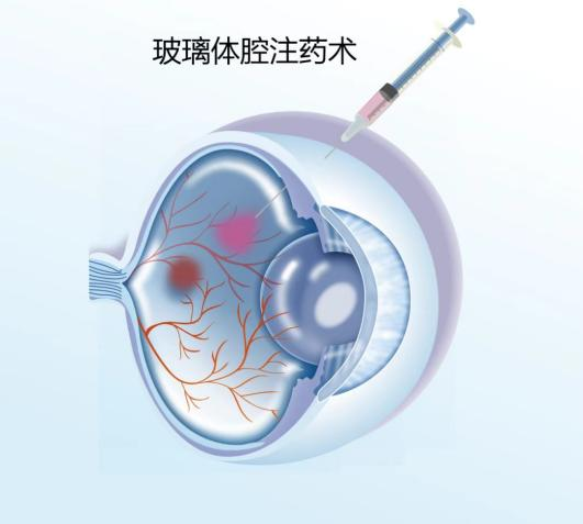 眼底注药到底是个撒？眼药水能代替眼内注药吗？