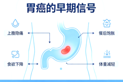 胃癌的早期信号：别把"小胃病"不当回事