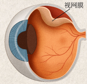 近视 600 度以上的人眼底正在悄悄改变?医生建议:每年一定要做这件事