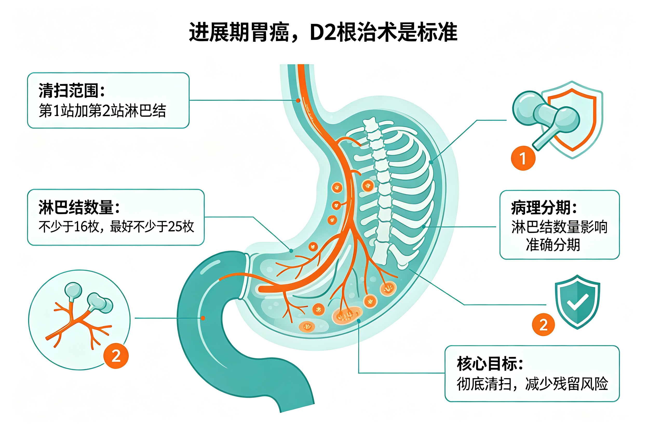 胃癌手术，"清扫淋巴结"比切肿瘤还重要