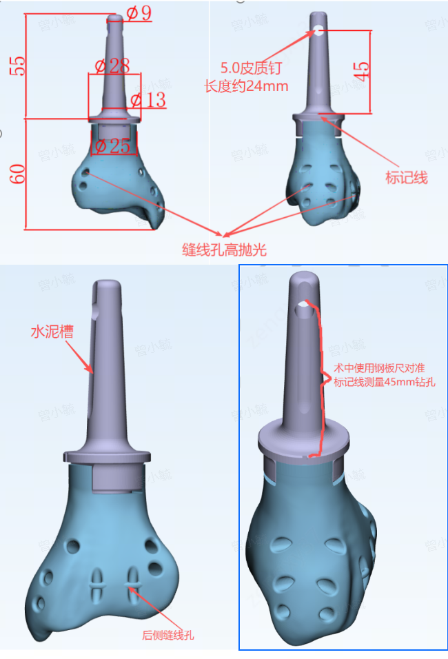 3D 打印"量体裁衣"!四川泰康医院完成复杂踝关节个性化假体置换