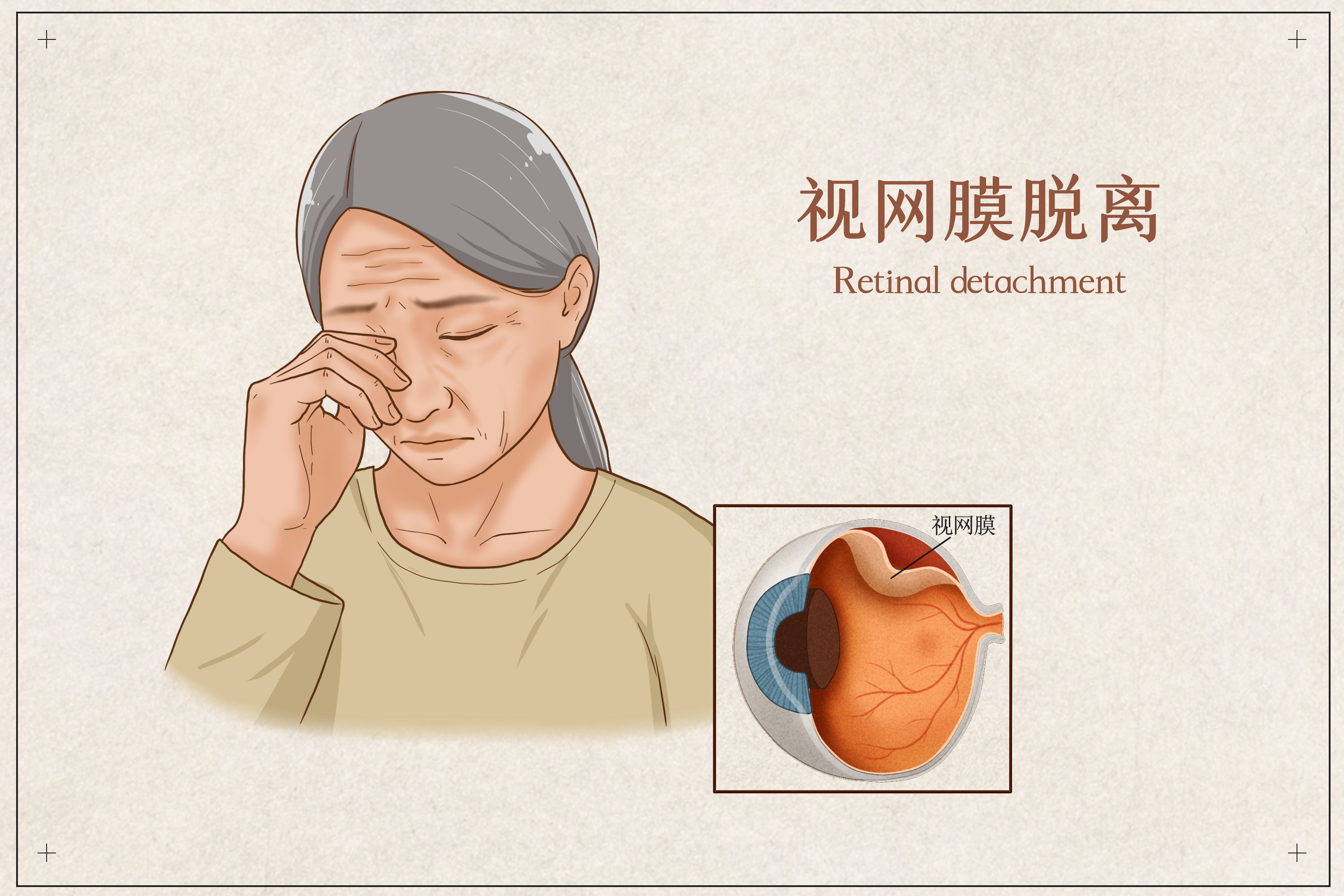 27 岁,近视一年涨了 100 多度:成年人的视力没有「安全期」