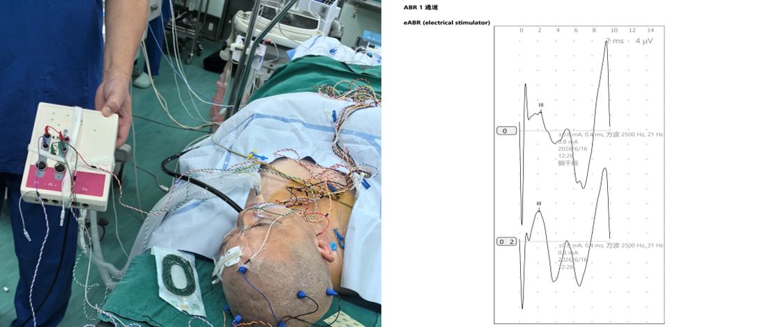 要「微笑」更要「好声音」,武汉专家破解听神经瘤切除难题