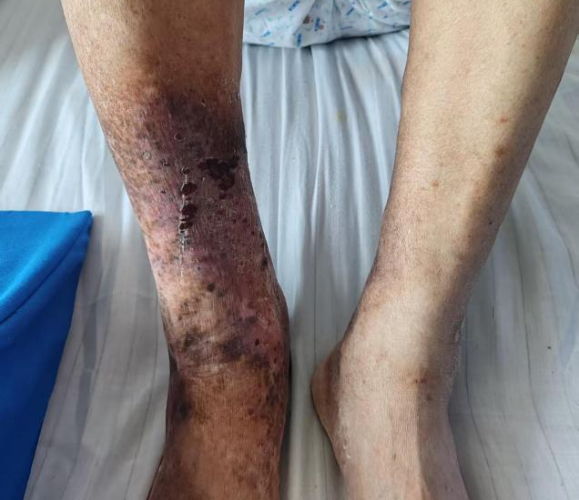 下肢水肿未必是血栓复发!这类隐蔽病因极易被误诊