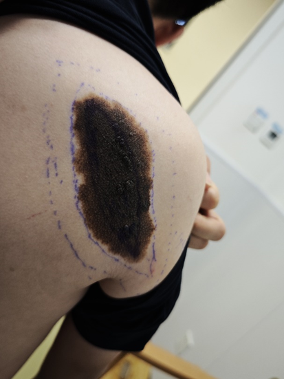 男孩身上「大块黑痣」不能一刀切？「等待」才是变好看的关键