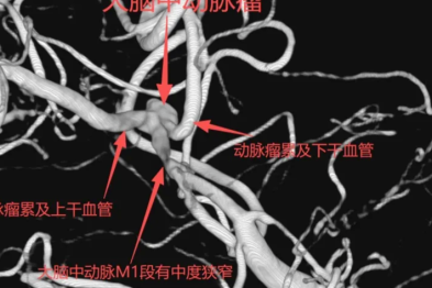 微创拆除颅内 「定时炸弹」！南京江北医院林涛副院长团队成功实施支架辅助颅内动脉瘤栓塞术