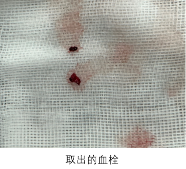 生死竞速！急性基底动脉闭塞患者 1 例