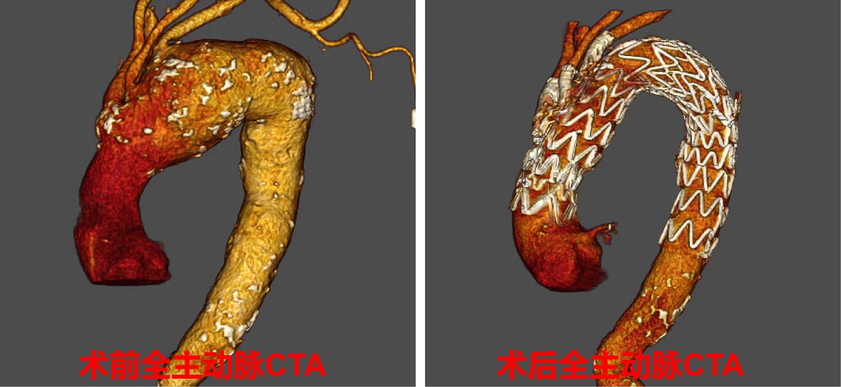 七旬老人体内藏巨型「血管炸弹」 心血管外科「三开窗」微创拆弹