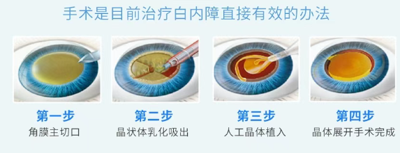 只有一只眼能看,角膜还有斑翳:这台白内障手术如何评估?