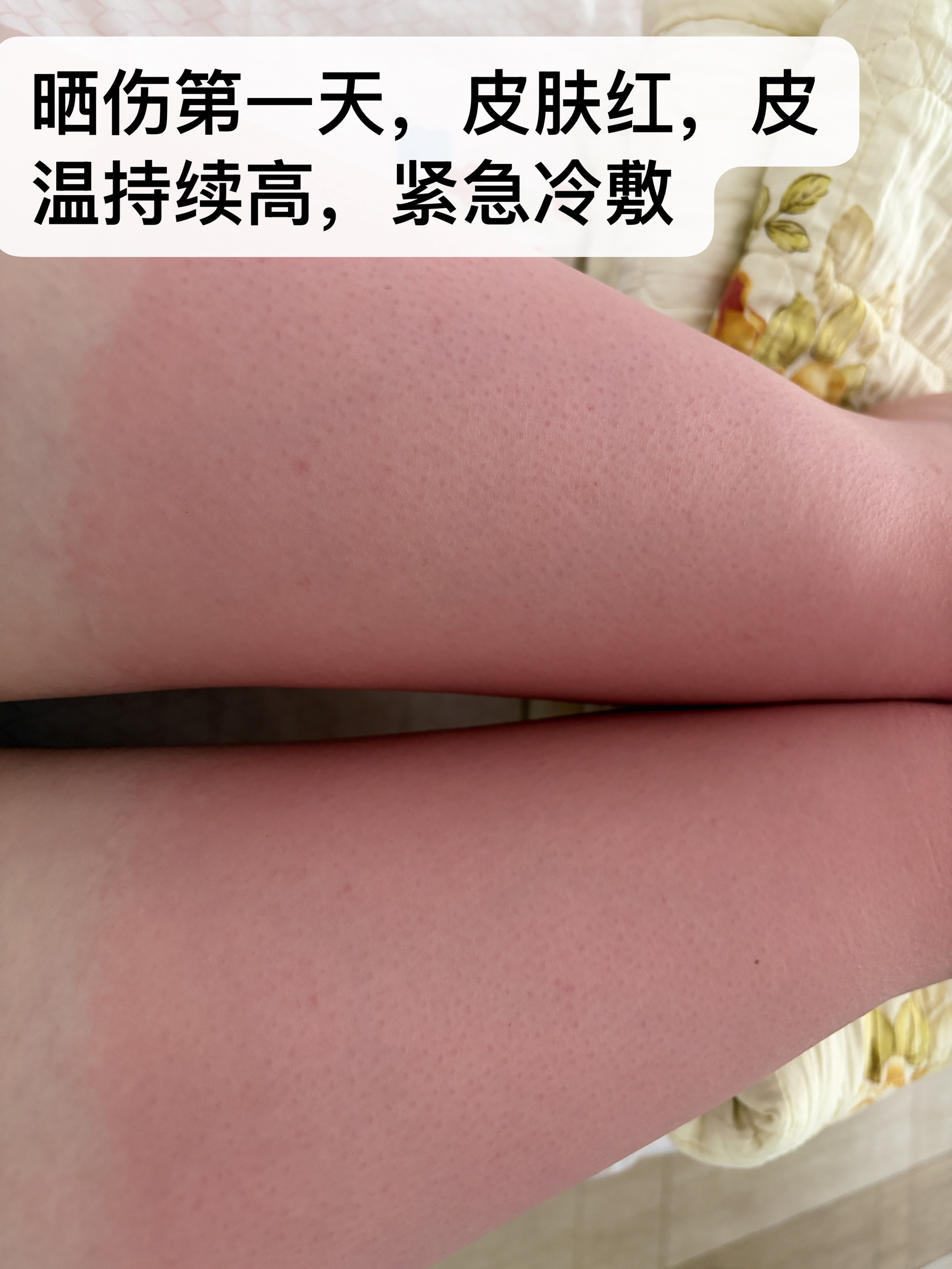 夏日皮肤晒伤与晒后紧急处理