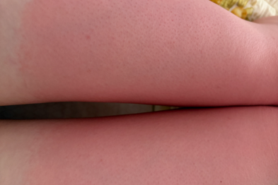 夏日皮肤晒伤与晒后紧急处理