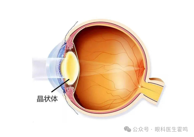 什么是晶状体脱位？