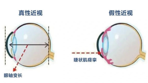 严宏院长温馨提示:孩子一旦确诊为近视,还能不能恢复?