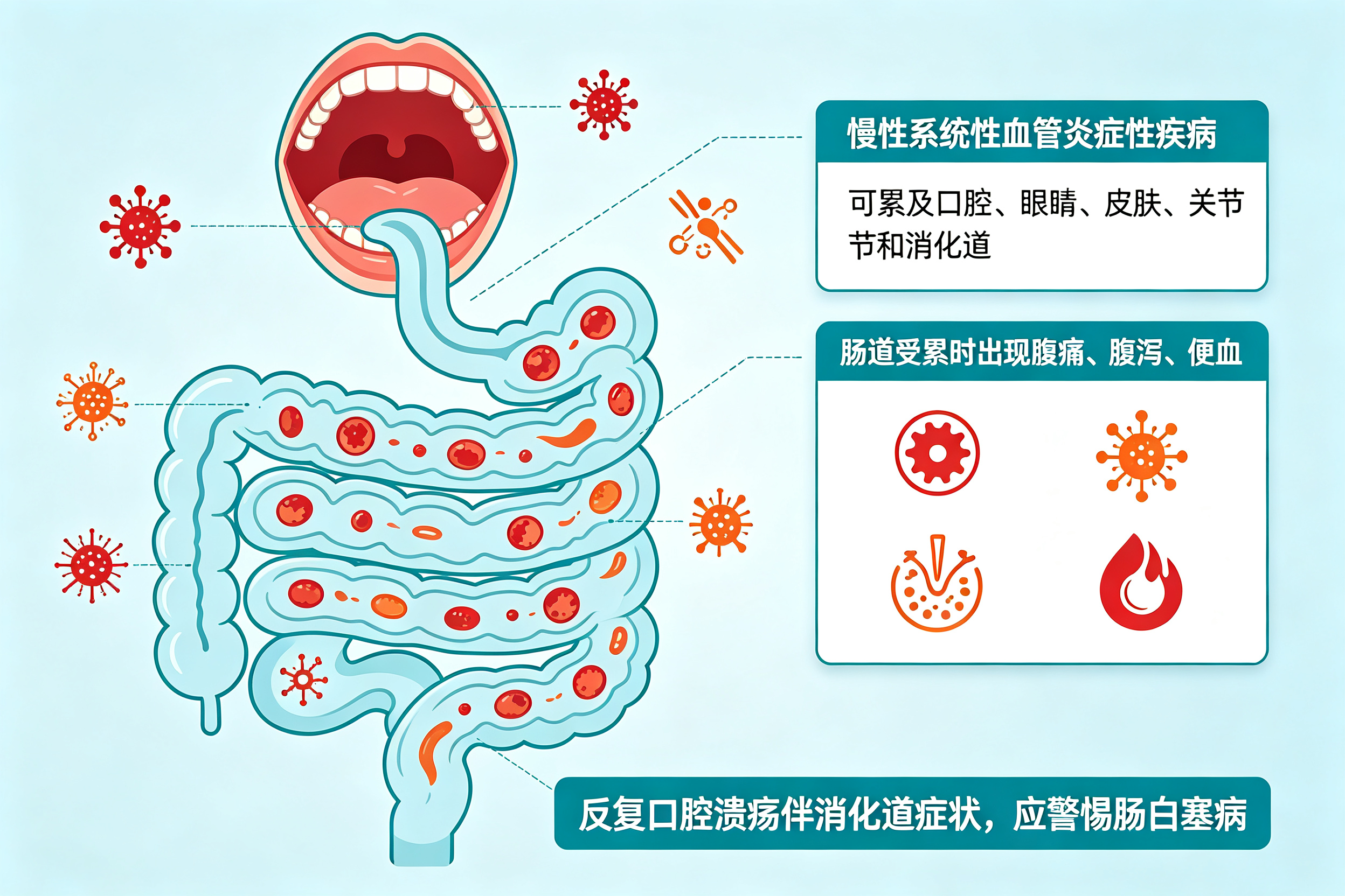反复口腔溃疡+腹痛腹泻，警惕肠白塞病
