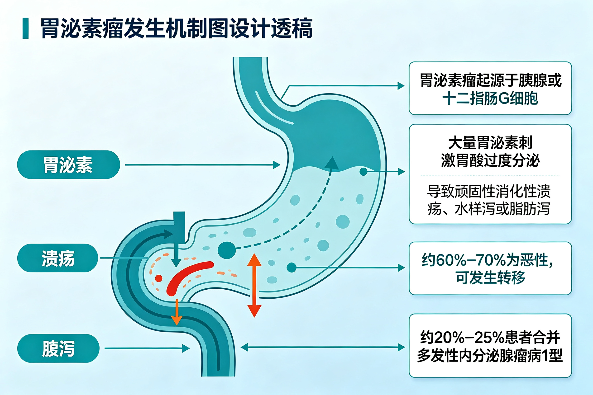 反复胃溃疡、腹泻，可能是这个瘤在作怪——胃泌素瘤