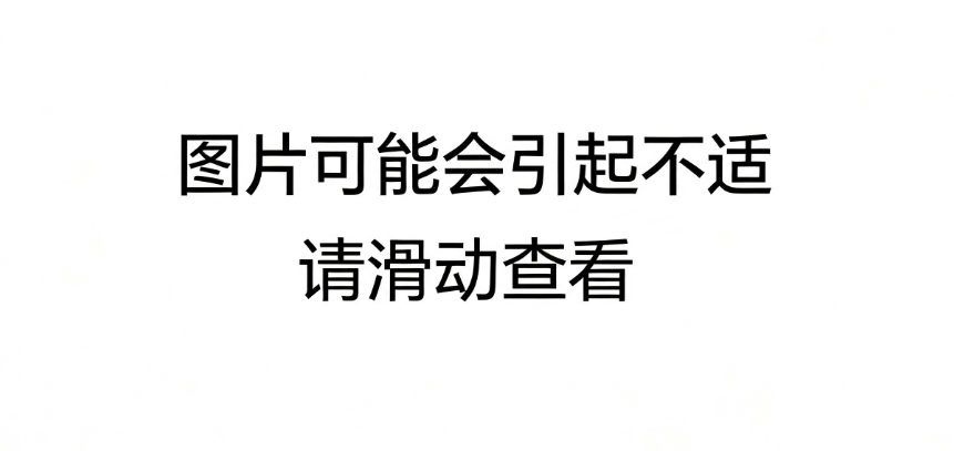 瑞金海南医院应用国际创新方案，为 6 岁骨肿瘤患儿完成自体骨重建