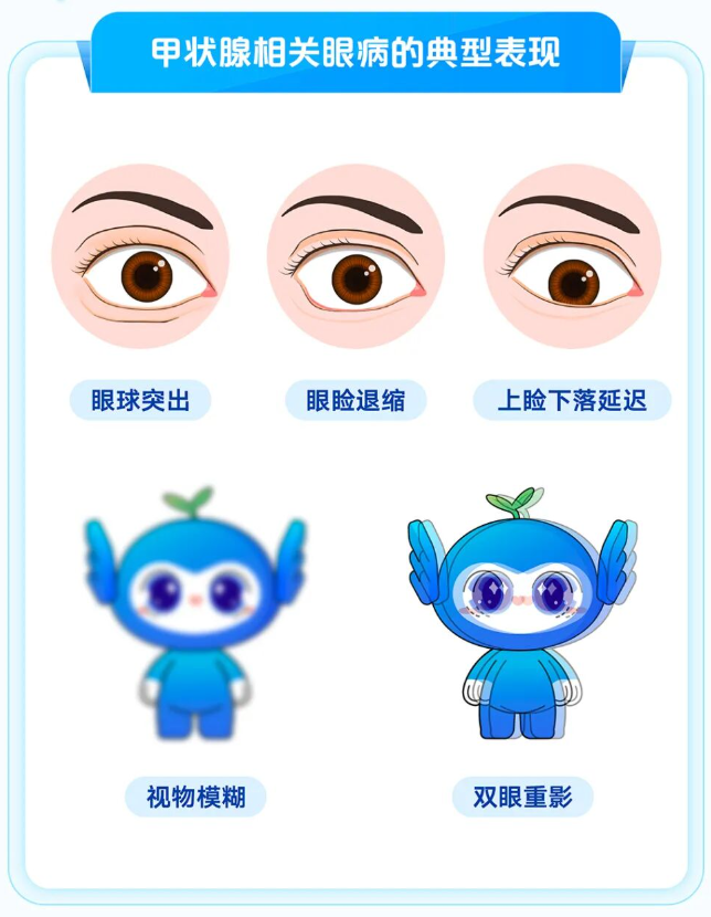 甲亢甲减致眼突,湛江爱尔奥理德眼科医院成立「甲状腺眼病门诊」护航精准诊疗