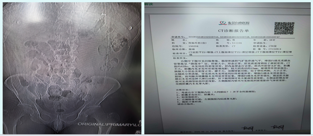罕见！男子小肠被纤维膜裹成「蚕茧」，东莞台心医院精细手术成功「破茧」