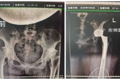 髋关节发育不良：忍了十年痛，最后换了两个「新关节」