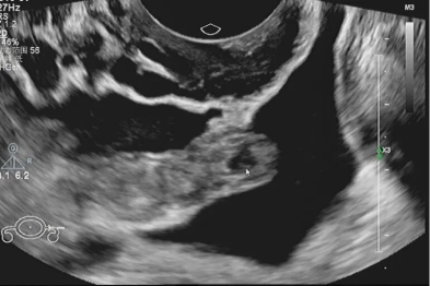 停经腹痛、异常出血：一例节育器位置正常异位妊娠带来的生殖健康警示