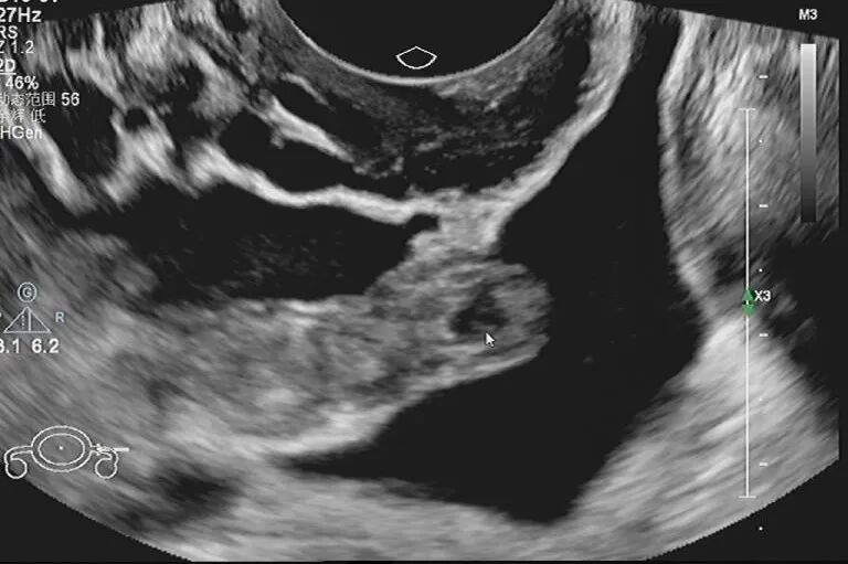 停经腹痛、异常出血:一例节育器位置正常异位妊娠带来的生殖健康警示