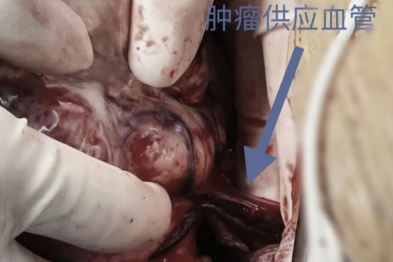 20 cm、8 斤！足球大的肿瘤被这群人成功取出