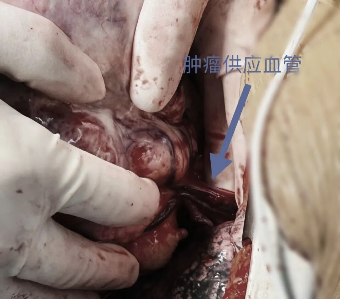 20 cm、8 斤！足球大的肿瘤被这群人成功取出
