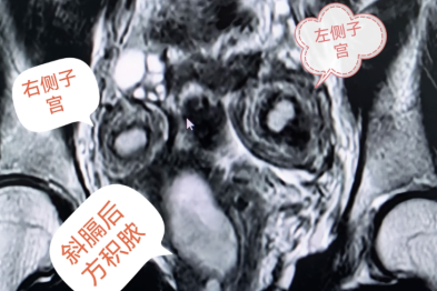 痛经十年，21 岁姑娘查出罕见病：体内竟多了道「隔断墙」