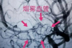 名字很温柔，发病很凶险！一文读懂脑血管病变烟雾病