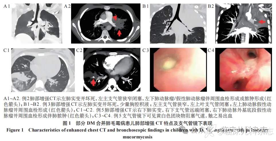儿童糖尿病合并肺毛霉病患者临床特征及预后分析