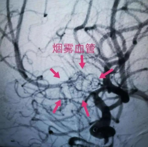 名字很温柔,发病很凶险!一文读懂脑血管病变烟雾病