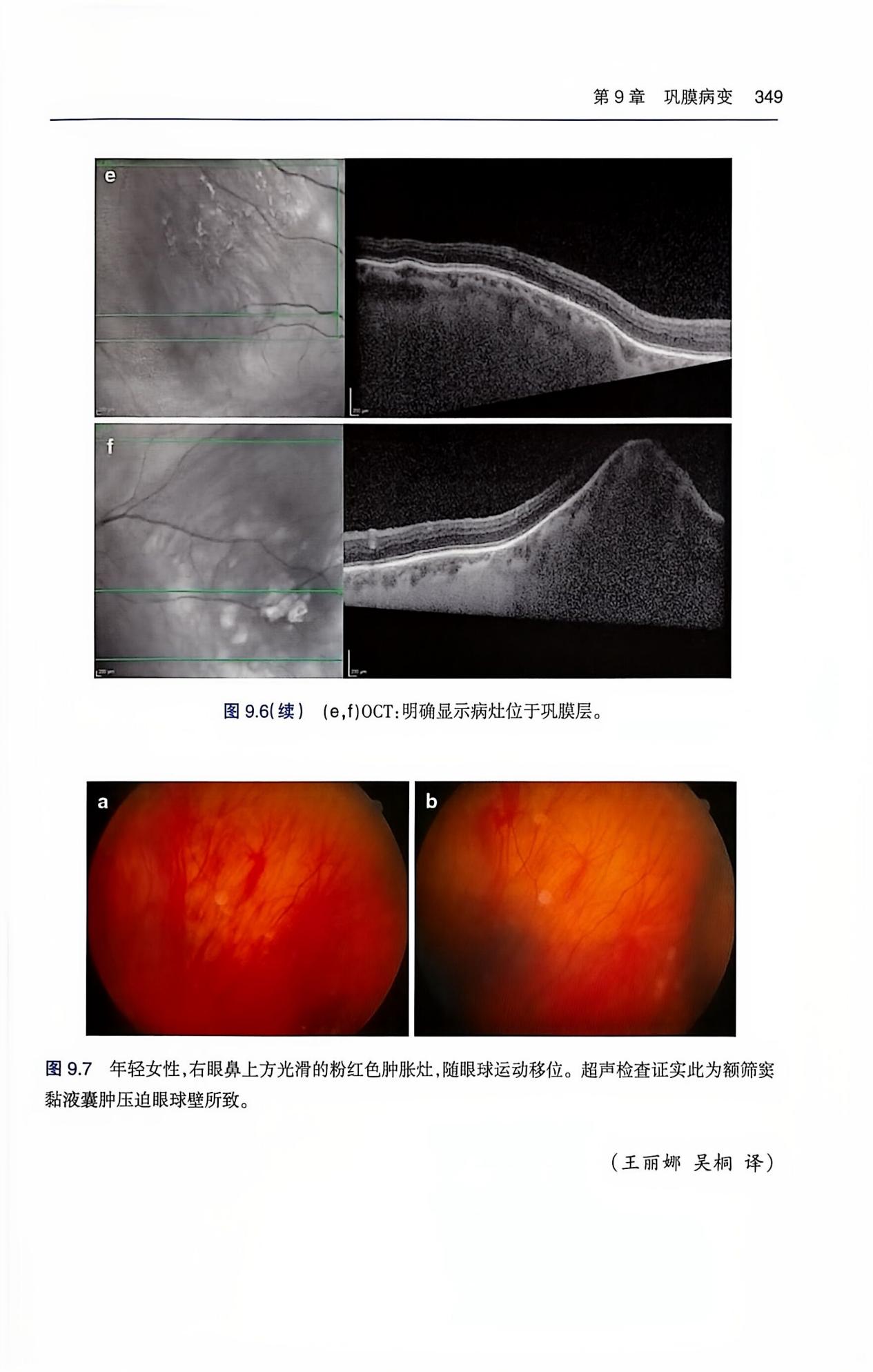 共享全球眼科智慧 | 孙丰源院长主审《临床眼肿瘤图谱》中文译版出版
